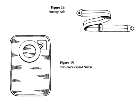 illustration showing an ostomy belt and two-pieced closed pouch