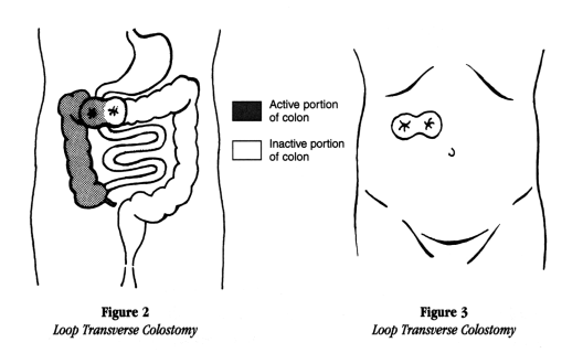 two views showing a loop transverse colostomy from inside the body and from outside detailing the active and inactive portions of the colon