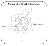 Illustration showing a standard or Brooke ileostomy where the end of the ileum is pulled through the abdominal wall and is turned back and sutured to the skin, leaving the smooth, rounded, inside-out ileum as the stoma.