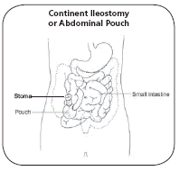 Illustration showing a continent ileostomy made by looping part of the ileum back on itself so that a reservoir or pocket is formed inside the belly (abdomen).