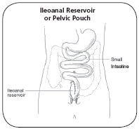Illustration of an ileo-anal reservoir (or pelvic pouch) made from the ileum and the rectum and placed inside the body in the pelvis.