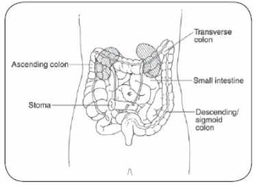 Illustration showing location of a stoma in relation to the ascending colon, transverse colon, small intestine and descending/sigmoid colon