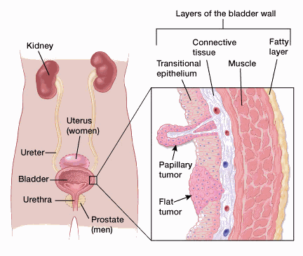 Illustration showing the location of the bladder in relation to the kidneys, uterus (in women), prostate (in men), ureter and urethra. There is also a close up showing the layers of the bladder wall with papillary and flat tumors.
