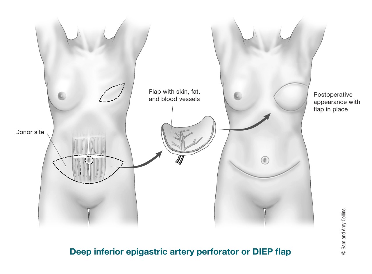 illustration showing the donor site for a DIEP flap, flap with skin, fat and blood vessels and the postoperative appearance with flap in place