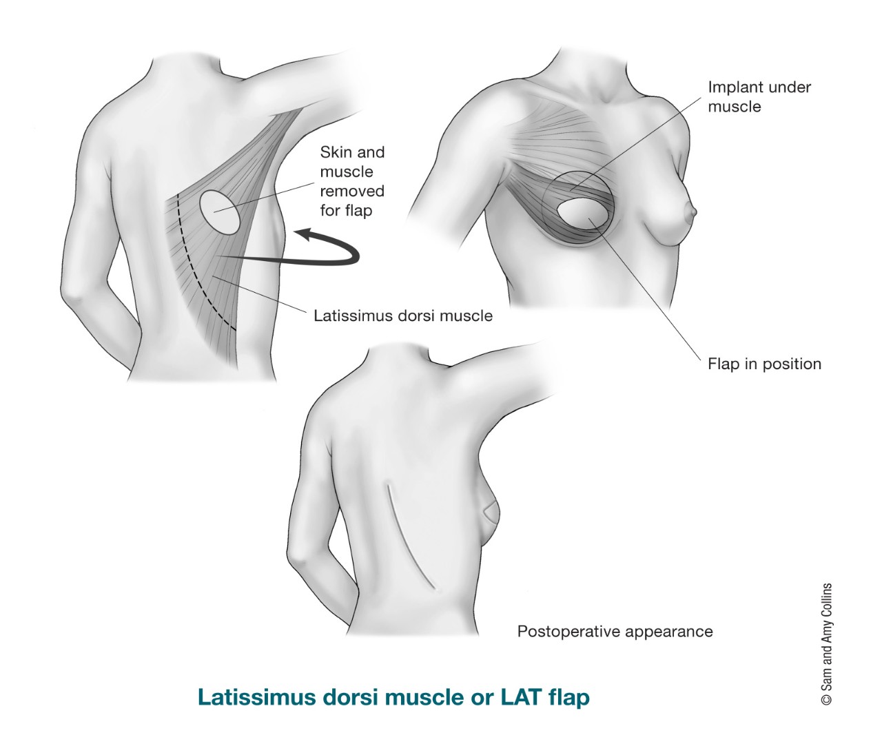 illustration showing the latissimus dorsi muscle and the skin and muscle removed for LAT flap. also shows the implant under muscle in the breast, the flap in position and the postoperative appearance