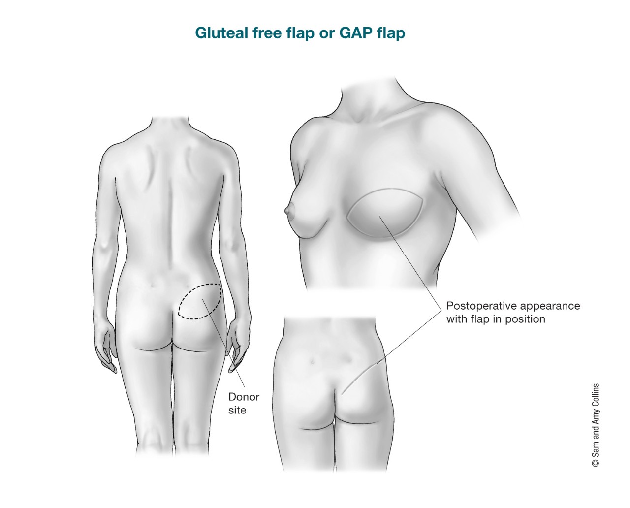 illustration showing the donor site of a GAP flap and the postoperative appearance with flap in position