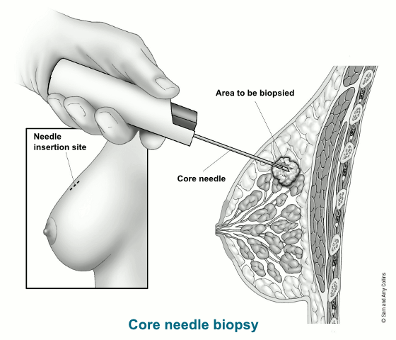 illustration showing the needle insertion site of a core needle biopsy along with details of the core needle and area to be biopsied