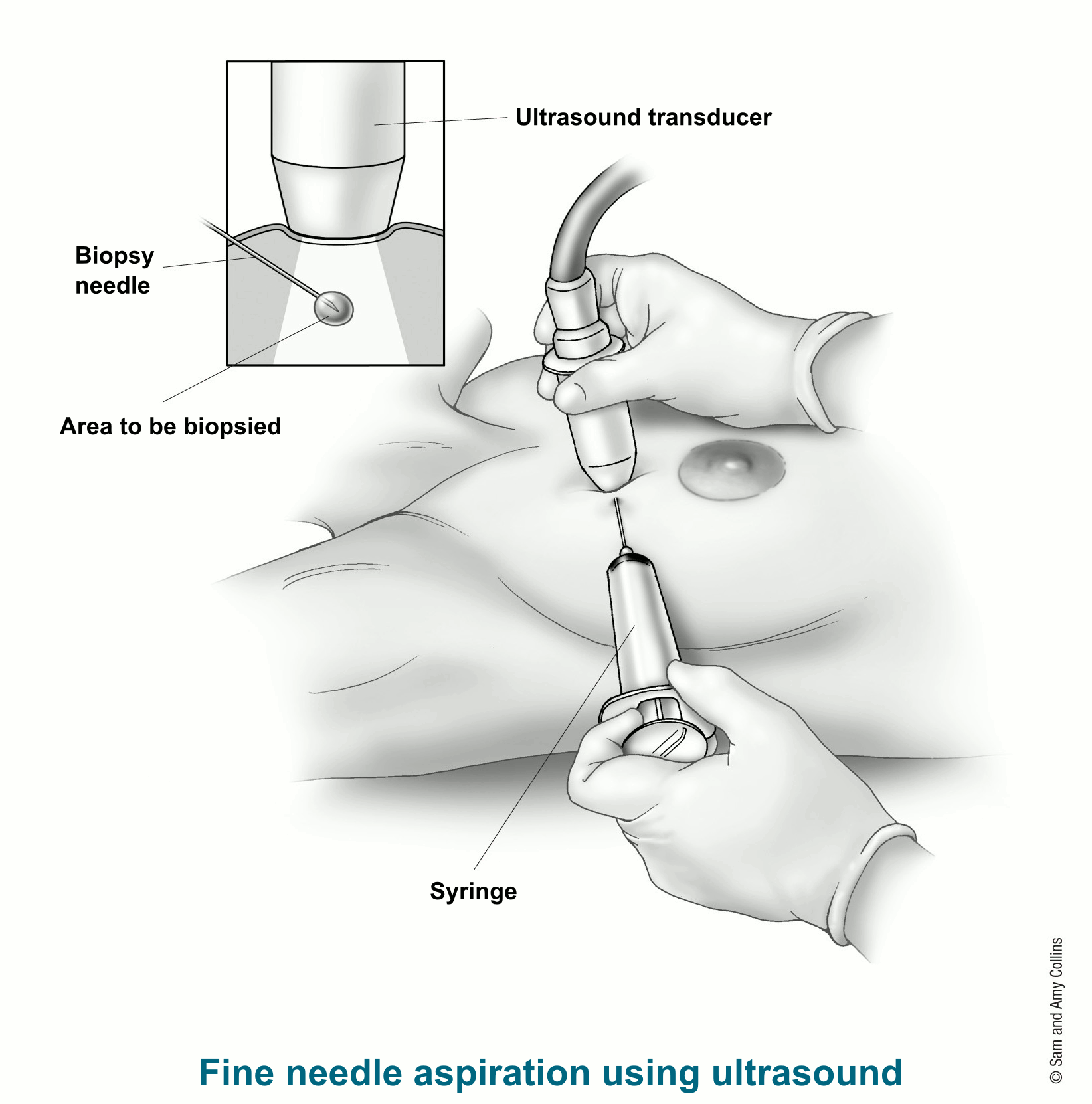 illustration showing a fine needle aspiration using ultrasound including detail of the biopsy needle, area to be biopsied and the ultrasound transducer