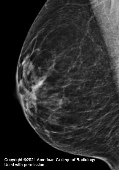 mammogram image showing a breast that has scattered areas of dense glandular and fibrous tissue