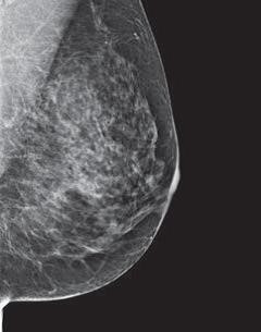 mammogram image showing a breast where more of the breast is made of dense glandular and fibrous tissue