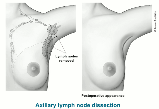 two illustrations showing lymph nodes removed with axillary lymph node dissection and the postoperative appearance