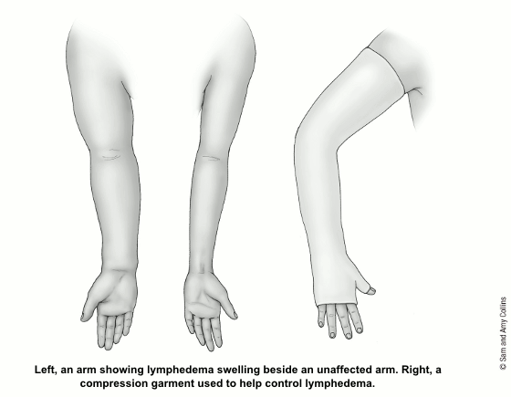 illustration showing an arm with lymphedema swelling, an unaffected arm and an arm with a compression garment used to help control lymphedema