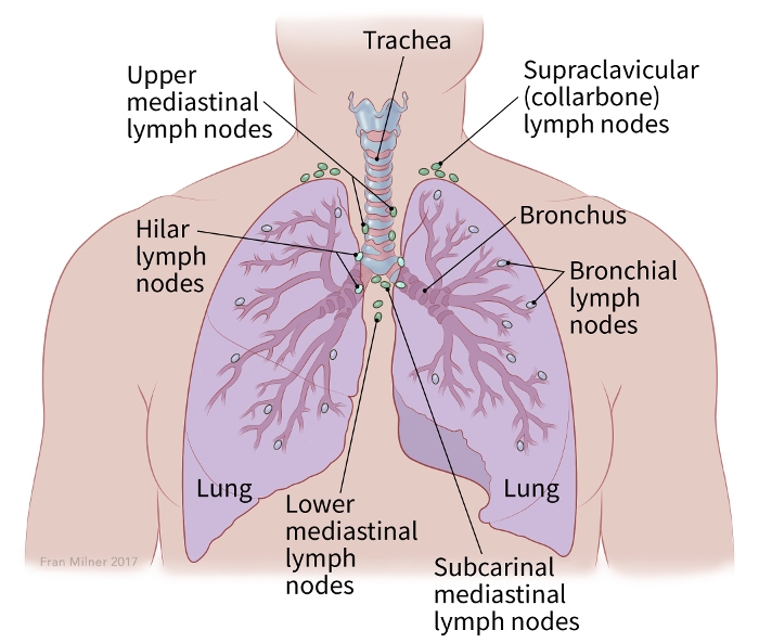 illustration showing the lungs, hilar lymph nodes, upper mediastinal lymph nodes, bronchial lymph nodes, bronchus, trachea, supraclavicular (collarbone) lymph nodes, lower mediastinal lymph nodes and subcarinal mediastinal lymph nodes