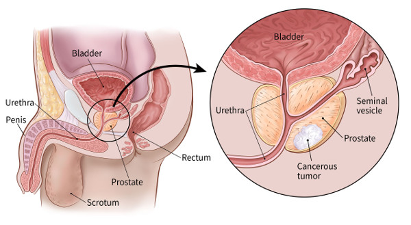 What is Prostate Cancer?