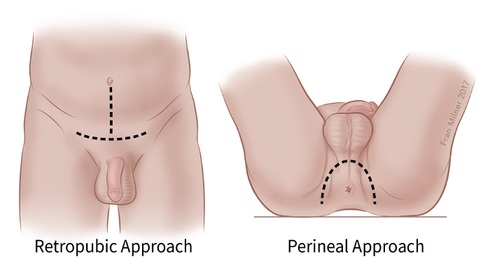 illustration showing the retropubic approach and perineal approach