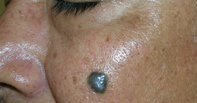 Basal cell skin cancer on a cheek, appearing on darker skin as a dark, raised, irregular area.