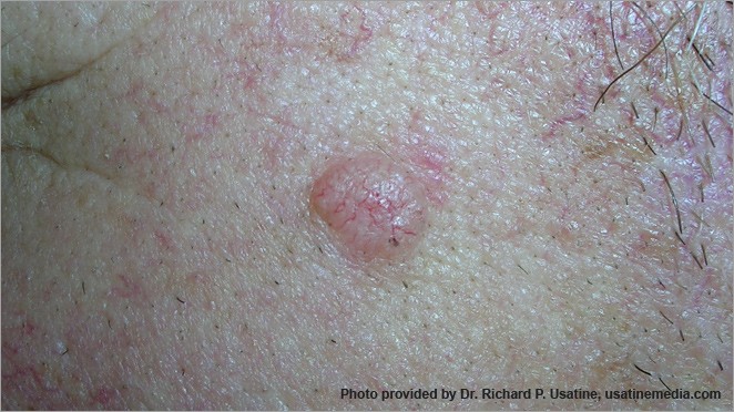 skin cancer moles on arms