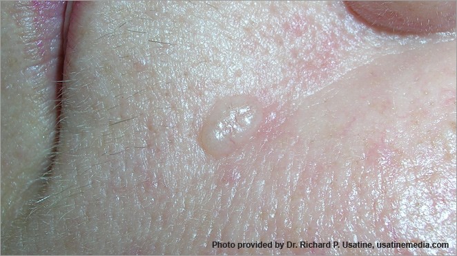 Basal cell carcinoma on light skin appearing as a small, shiny, pale bump.