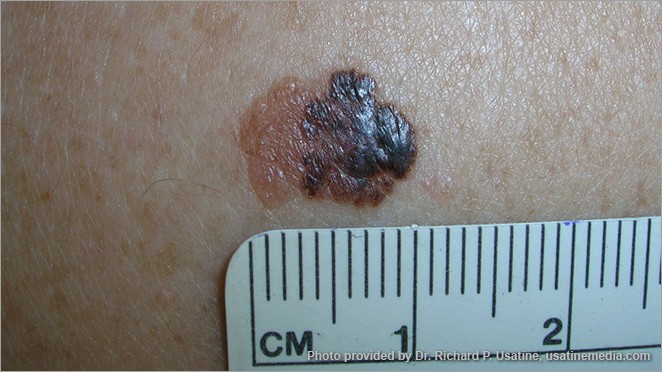 Melanoma appearing on light skin as an irregular area, partly dark, partly light, and partly raised, with a jagged border.