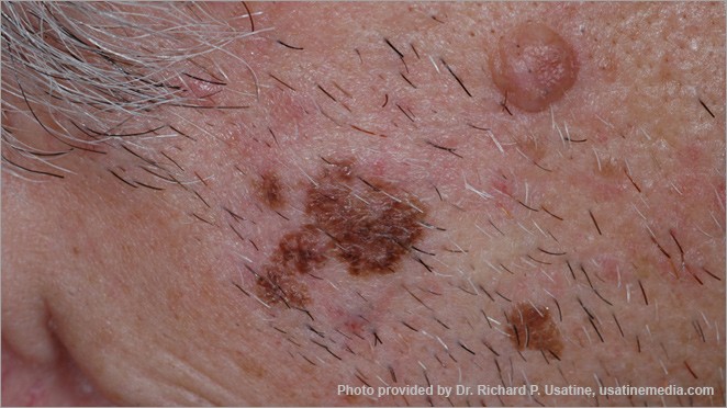Melanoma appearing on light skin as a light brown, irregular, patchy area.