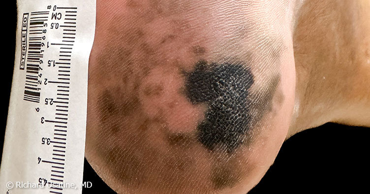 Galería sobre el cáncer de piel | American Cancer Society