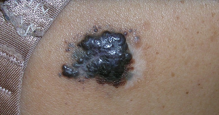 melanotic sarcoma skin cancer Skin Cancer Pictures | Skin Cancer Images | What Does Skin Cancer Look  Like?