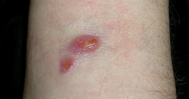 Skin Cancer Pictures, Skin Cancer Images, What Does Skin Cancer Look  Like?