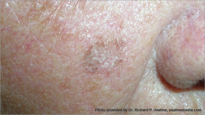 Squamous cell carcinoma on the face, appearing on light skin as a flat, slightly scaly, light brown patch.
