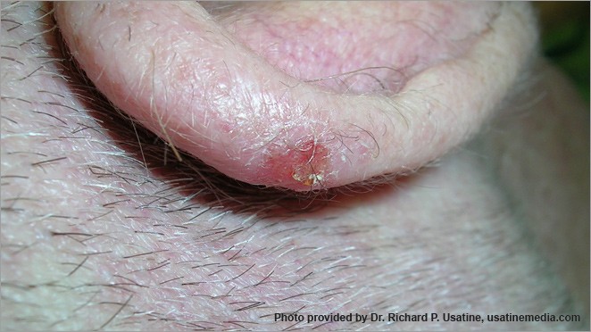 Squamous cell carcinoma on an ear, appearing on light skin as a small pink sore.