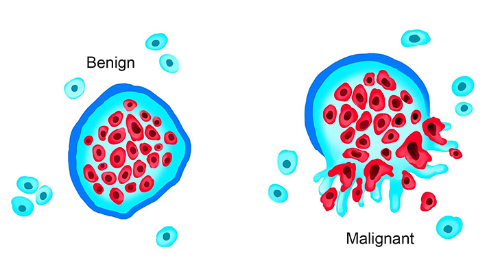 What Are Neoplasms and Tumors? | American Cancer Society