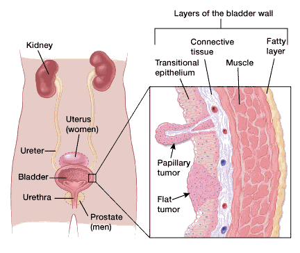 papilloma bladder cancer