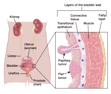 can u still get ovarian cancer after hysterectomy