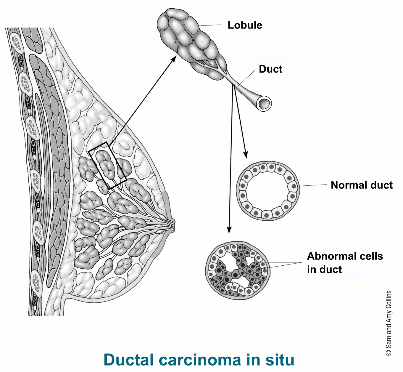 Ductal Carcinoma In Situ Pictures – The Meta Pictures