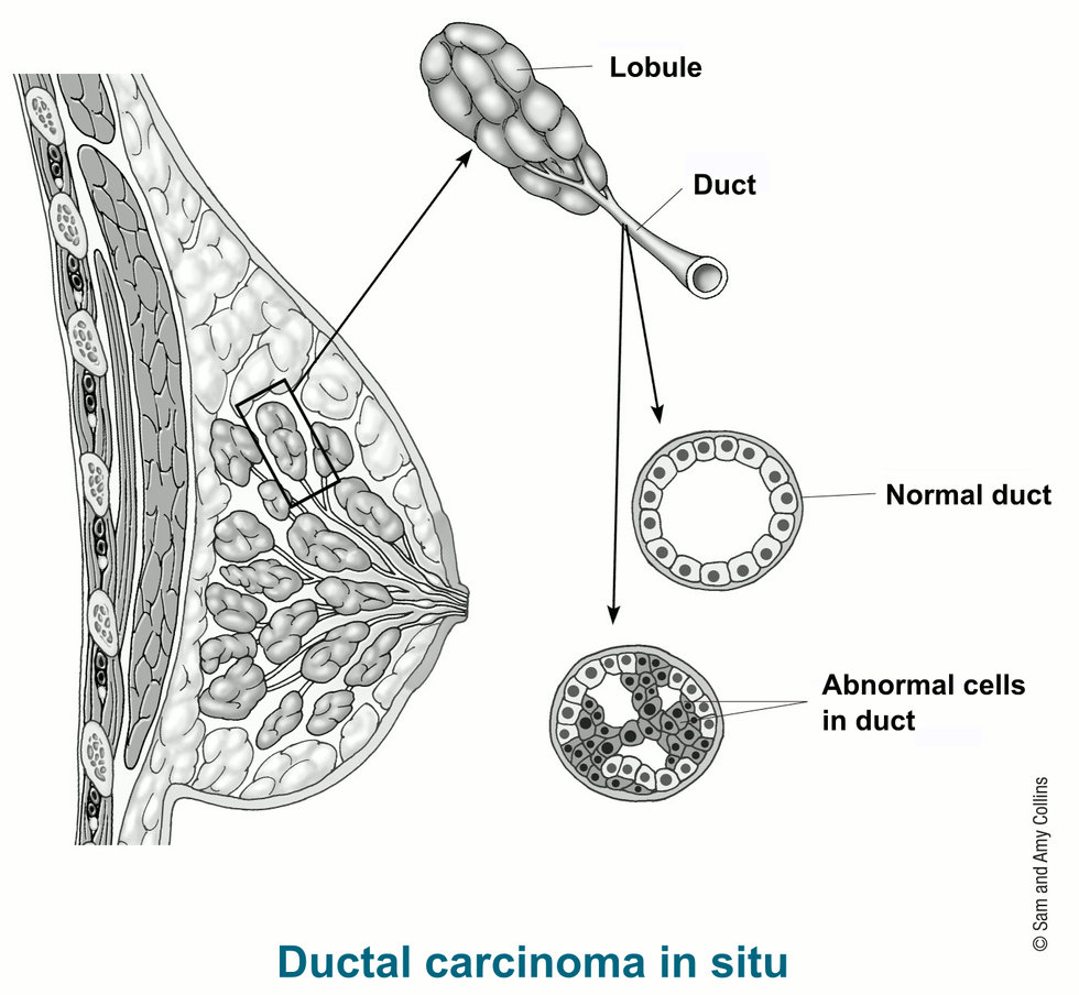 иллюстрация, показывающая детали протоковой карциномы in situ, включая дольку, проток, нормальный проток и аномальные клетки в протоке