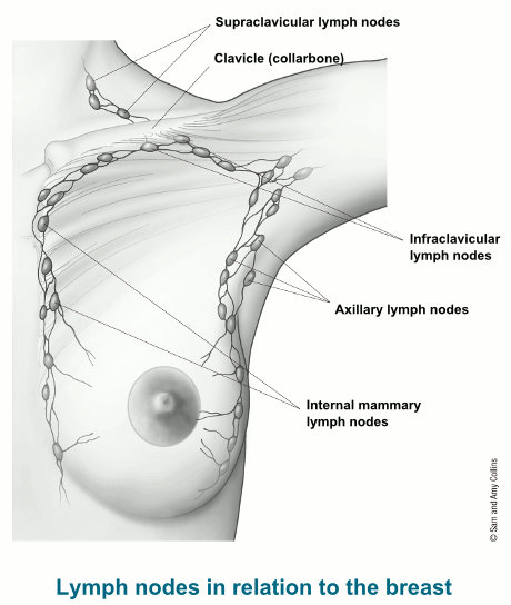 иллюстрация, показывающая надключичные, подключичные, подмышечные и внутренние молочные лимфатические узлы по отношению к груди