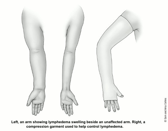 иллюстрация, показывающая руку с отеком лимфедемы, здоровую руку и руку с компрессионным бельем, используемым для контроля лимфедемы