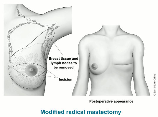 иллюстрация, показывающая разрез, ткань молочной железы и удаляемые лимфатические узлы, а также послеоперационный вид