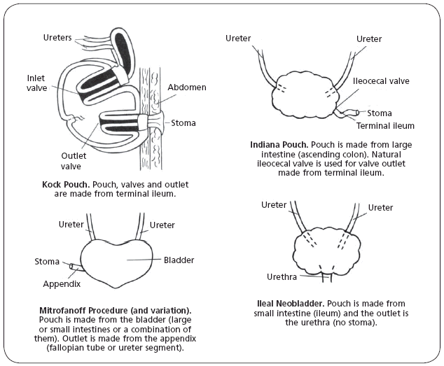 Urinary Diversion American Cancer Society