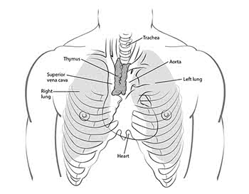 What Is Thymus Cancer
