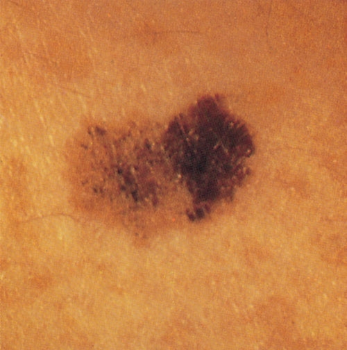 Foto af muldvarp, der viser asymmetri, uregelmæssighed i kanten og farve