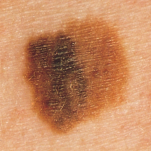 Photo of mole showing asymmetry, border irregularity, and color