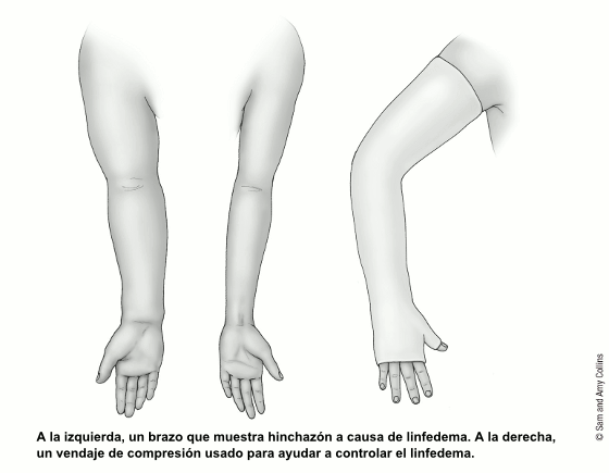 Ilustración de un brazo sin linfedema y un brazo con linfedema a la izquierda. A la derecha un brazo con un vendaje de compresión