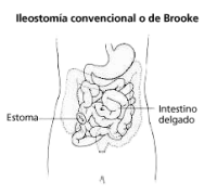 standard-or-brooke-ileostomy-spanish.gif