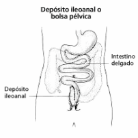 ileo-anal-reservoir-or-pelvic pouch-spanish.gif