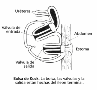 continent-urostomies-kock-pouch-spanish.gif