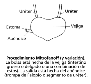continent-urostomies-mitrofanoff-procedure-spanish.gif