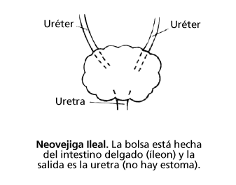 continent-urostomies-ileal-neobladder-spanish.gif