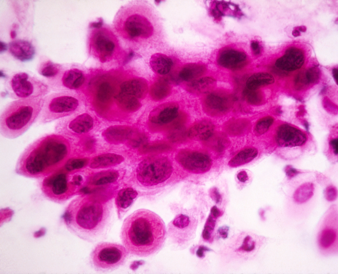slide showing cervical cancer cells