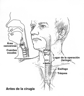 laryngectomy-before-surgery-spanish.gif