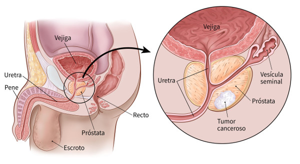 color illustration showing the prostate and surrounding area (including the location of the urethra, penis, scrotum, rectum, bladder and seminal vesicle)